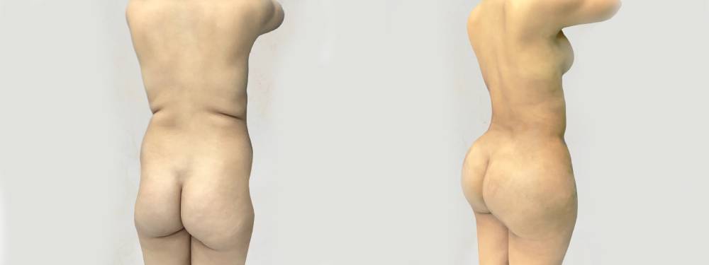 BBL  before and after