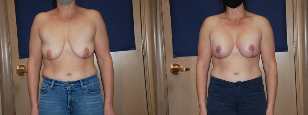 Breast Lift
