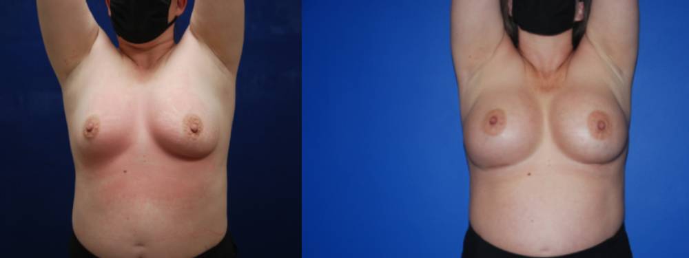 Breast Augmentation