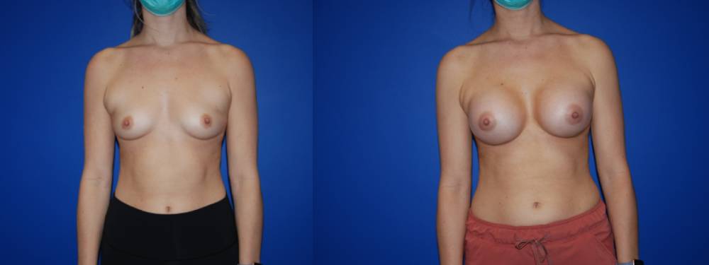 Breast Augmentation