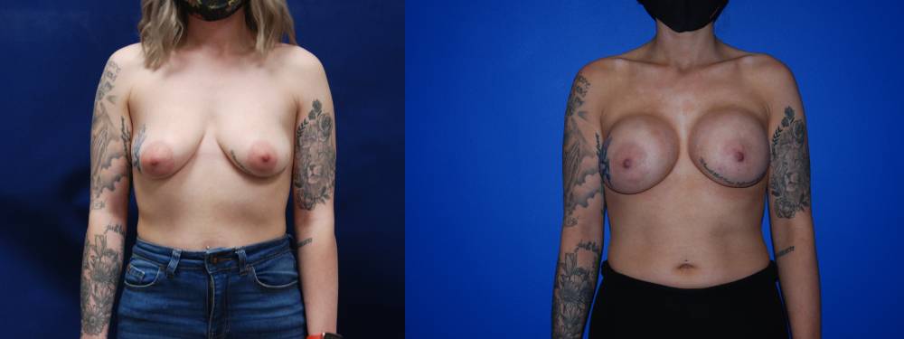 Breast Augmentation