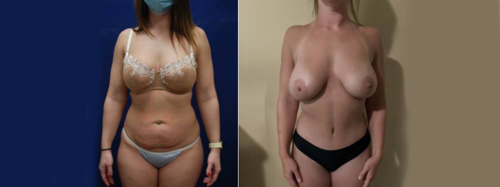 Tummy Tuck