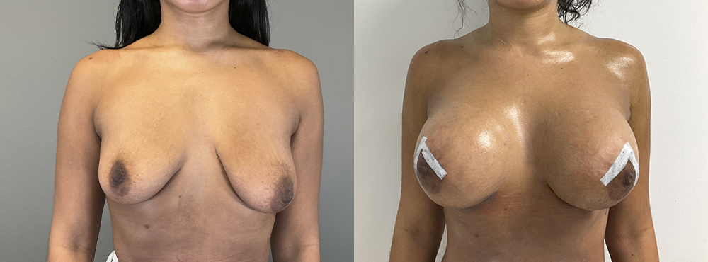 Breast Augmentation Before and After