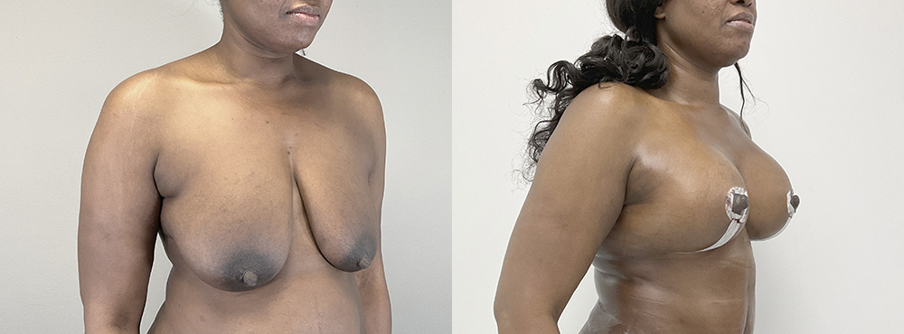 Breast Lift  Before and After