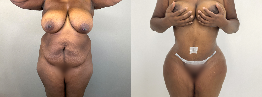 Tummy Tuck Before and After