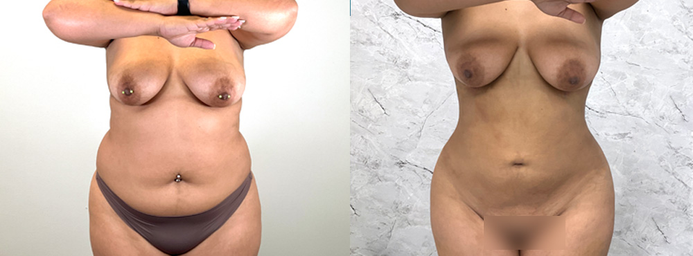 Lipo 360 Before and After Front