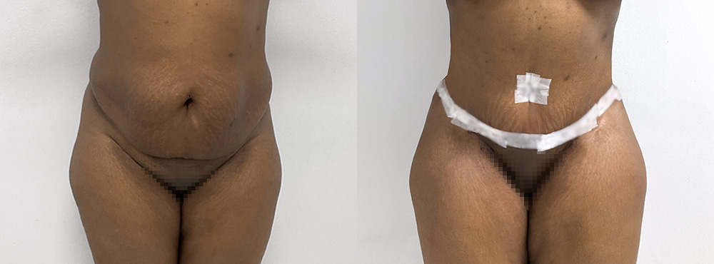Tummy Tuck Before and After