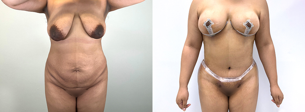 Mommy Makeover Before and After