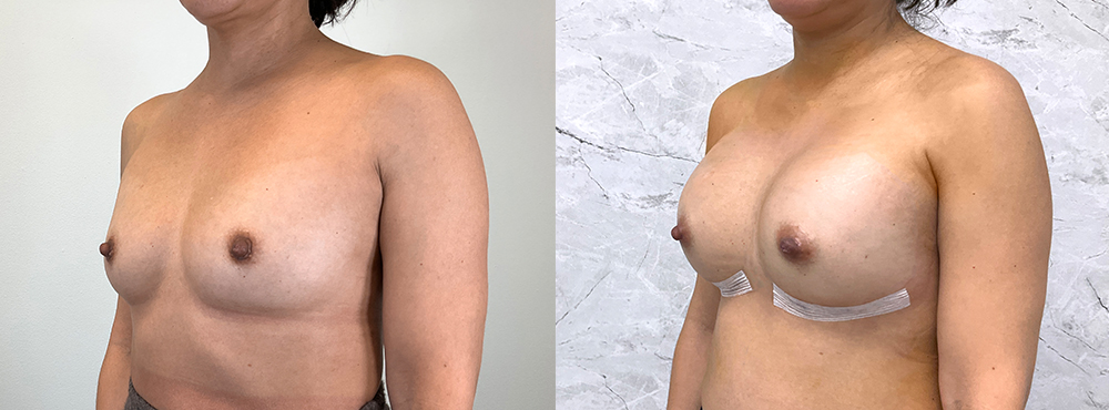 Breast Augmentation Before and After