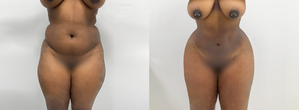 BBL Before and After