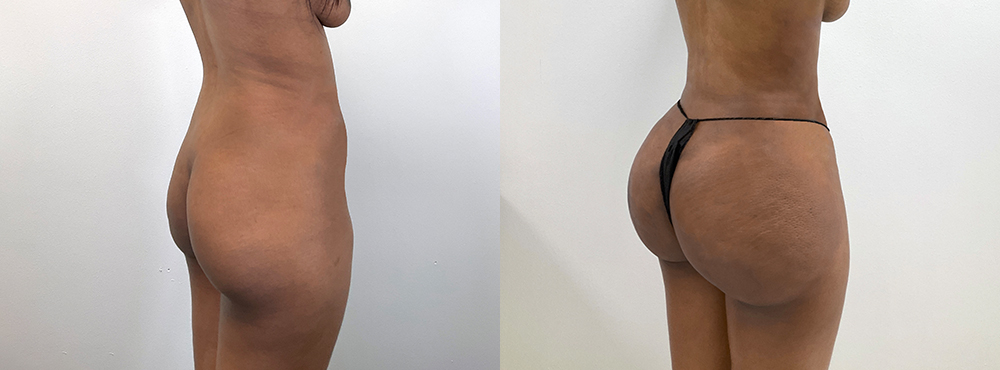 BBL Before and After