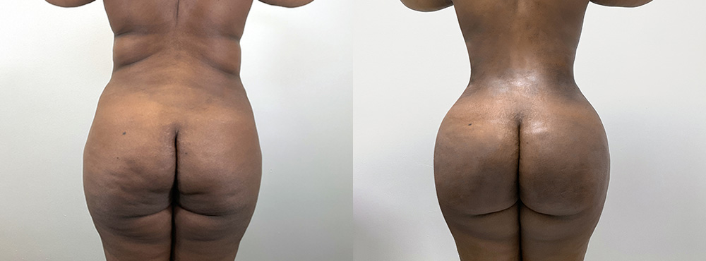 BBL Before and After