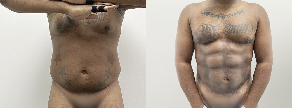 Abdominal Etching Before and After