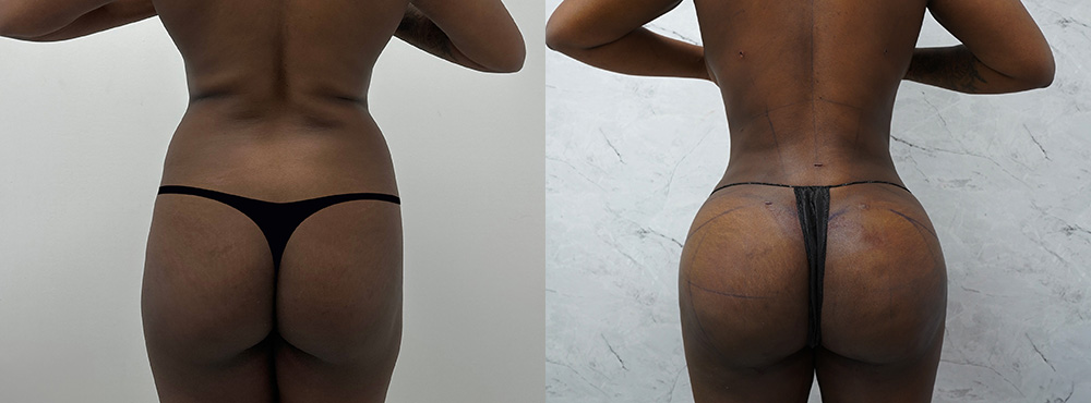 Brazilian Butt Lift Before and After