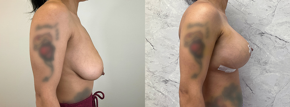 Breast Lift Before and After