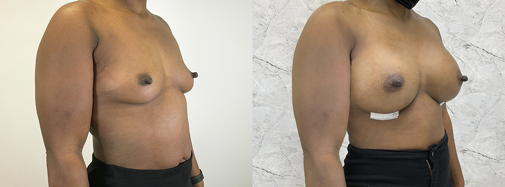 Breast Augmentation Before and After