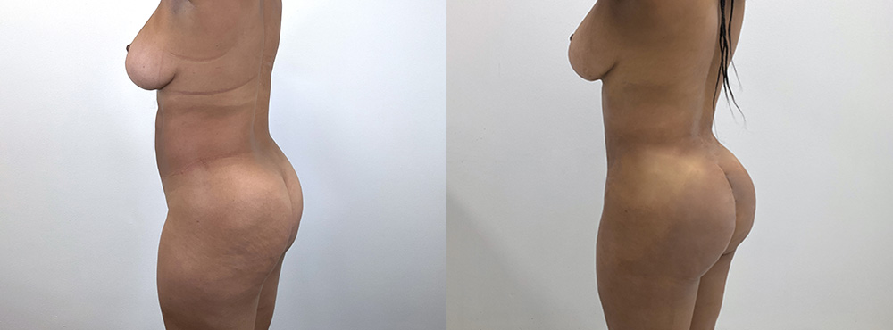 BBL Before and After