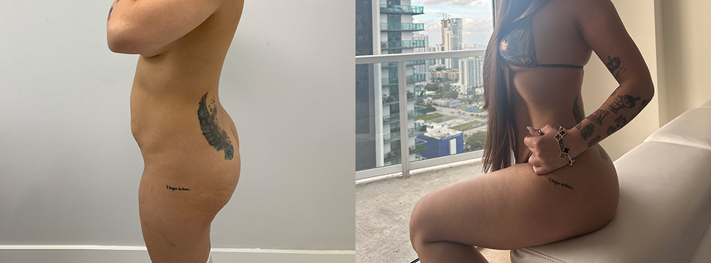 Mommy Makeover Before and After