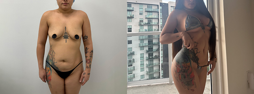 Mommy Makeover Before and After