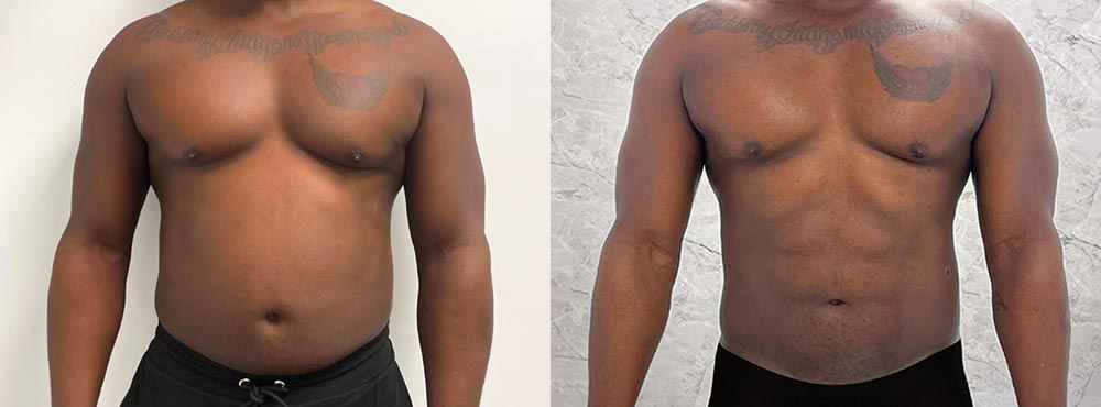 Male Abdominal Etching Miami Before and After
