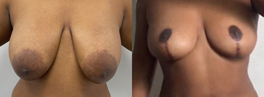 Breast Lift Before and After