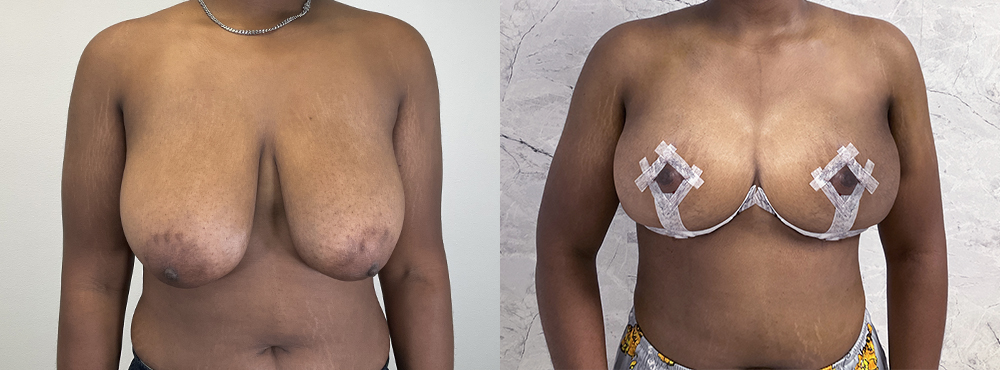 Breast Lift Before and After
