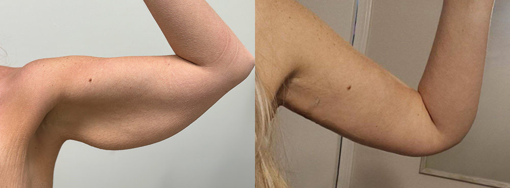 Arm lift Before and After in Miami