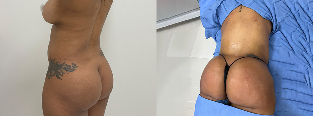Brazilian Butt Lift Before and After