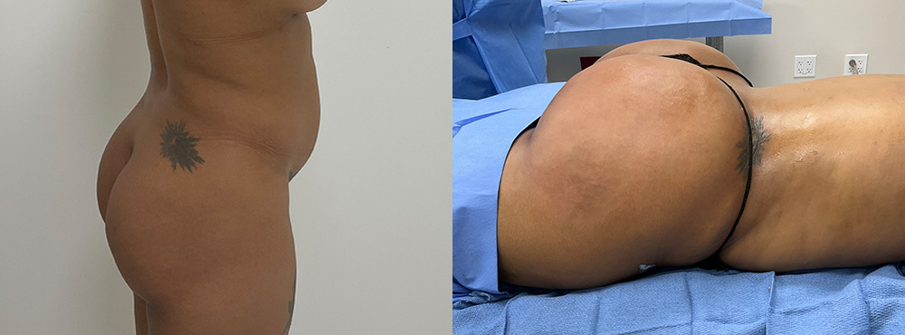 Brazilian Butt Lift Before and After