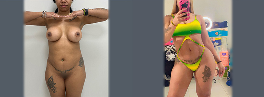 Brazilian Butt Lift Before and After