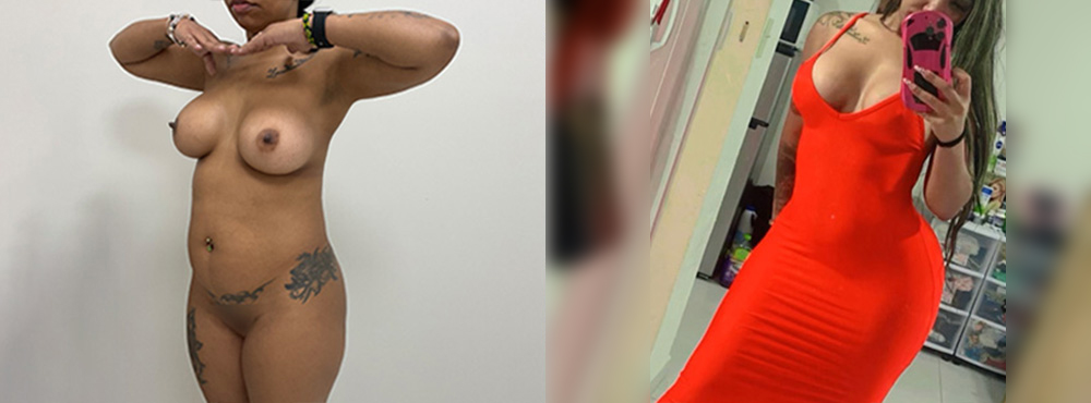 Brazilian Butt Lift Before and After
