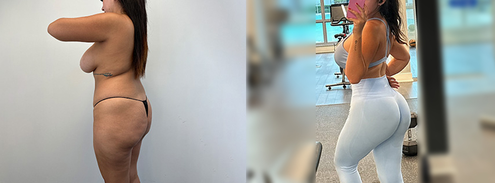 Brazilian Butt Lift before and after 