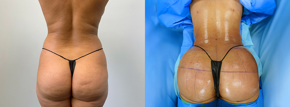 Brazilian Butt Lift Before and After