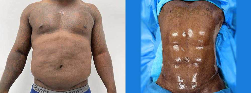 Male Abdominal Etching Before And After