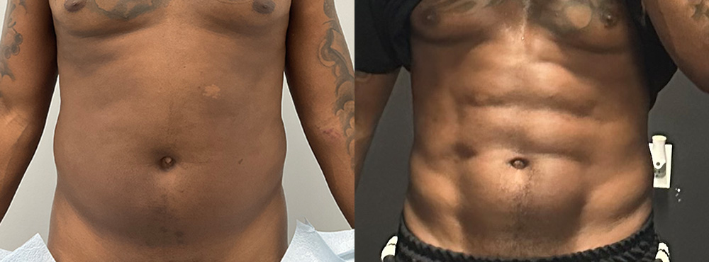Abdominal Etching Before and After
