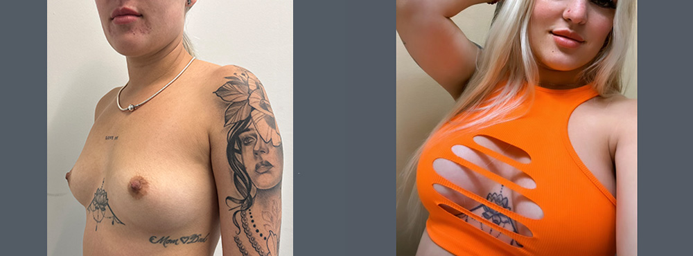 Breast Augmentation Before and After