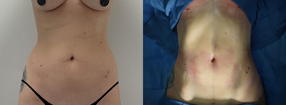 Abdominal Etching Before and After