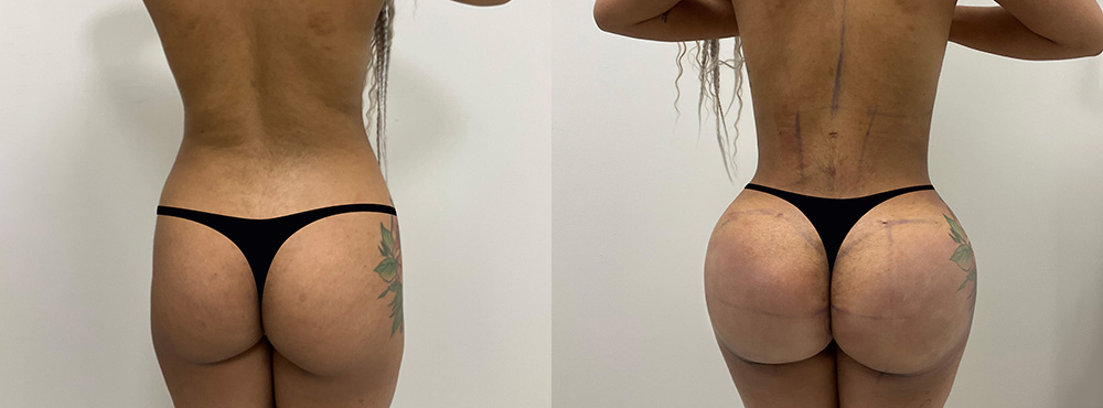 Brazilian Butt Lift Before and After in Miami
