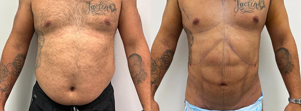 Six Pack Surgery Miami Before and After