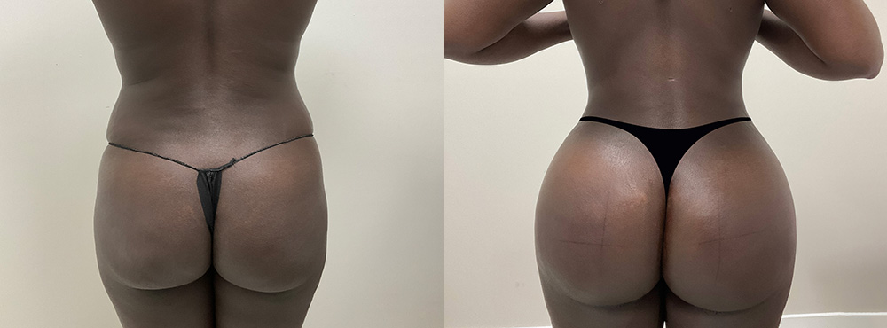 Brazilian Butt Lift Before and After