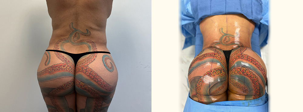 BBL Before and After in Miami