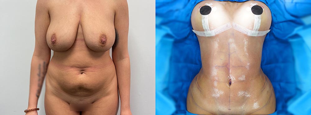 ab sculpting surgery before and after