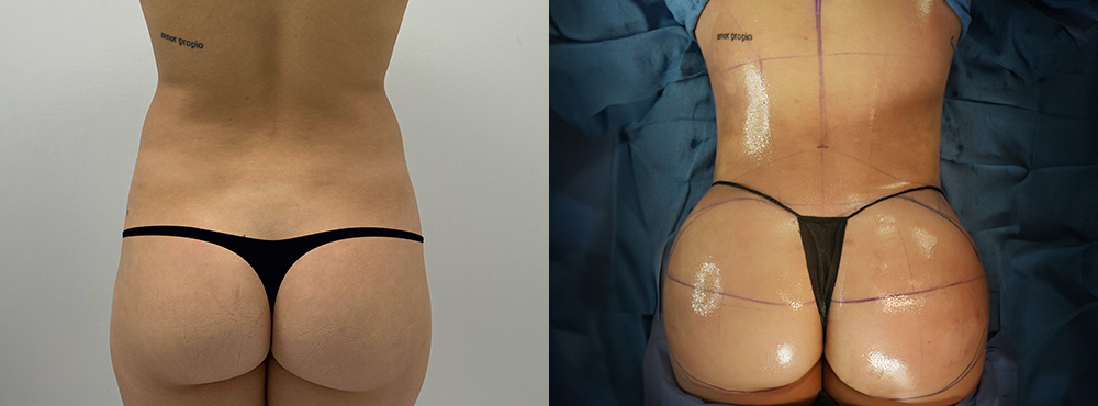 Brazilian Butt Lift Before and After