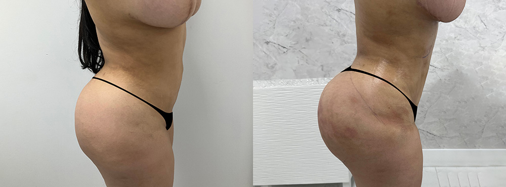 Brazilian Butt Lift before and after in miami