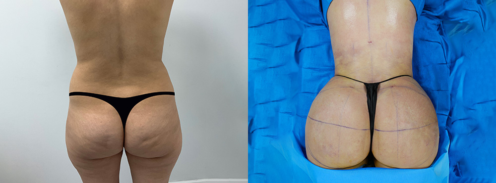 Brazilian Butt Lift Before and After in Miami