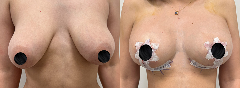 Breast Lift before and after