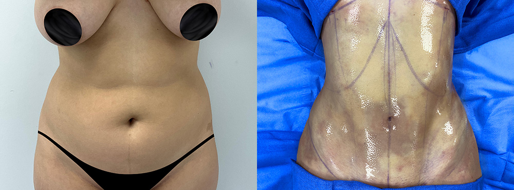 Lipo 360 Before and After