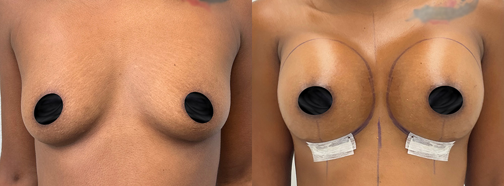 Breast Augmentation before and after in miami