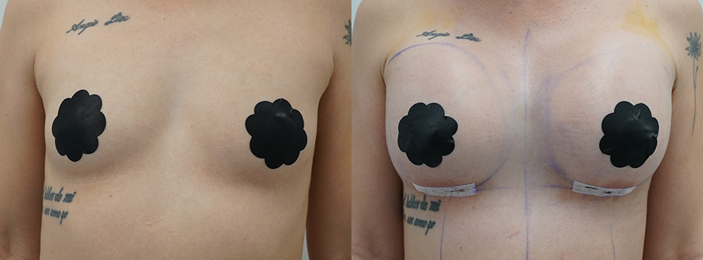 Breast Augmentation before and after in miami