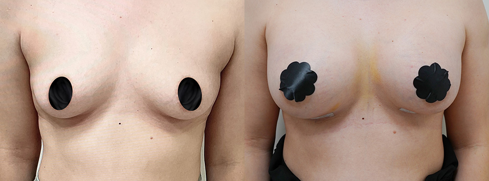 Breast Augmentation before and after in miami